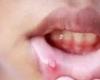بعض العلامات في الفم تشير الى مرض خطير