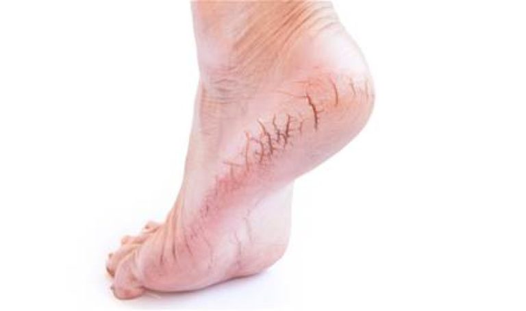 بالملح-والسكر.-وصفات-لعلاج-تشققات-القدمين-في-الشتاء