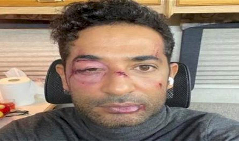 الفنان-الشهير-يرعب-جمهوره.-ظهر-بوجه-مليء-بالكدمات-والجروح!