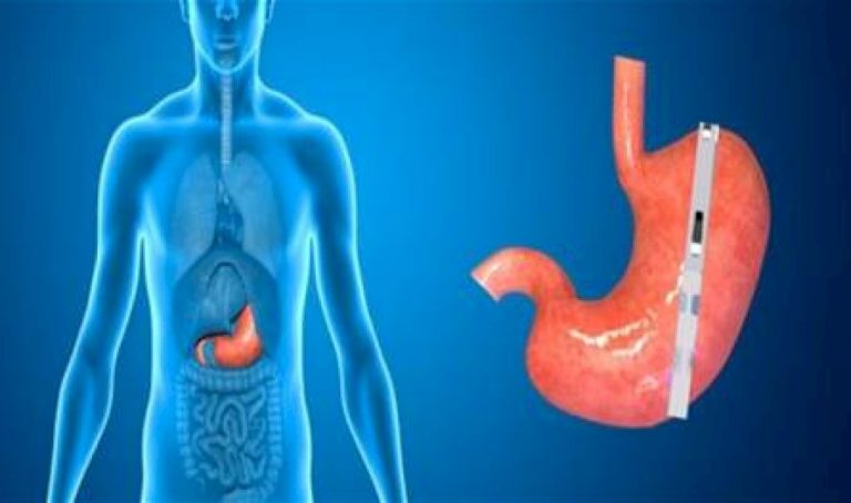 بكلة المعدة.. تقنية جديدة وسهلة جدًا لإنقاص الوزن بكلة-المعدة.-تقنية-جديدة-وسهلة-جدًا-لإنقاص-الوزن
