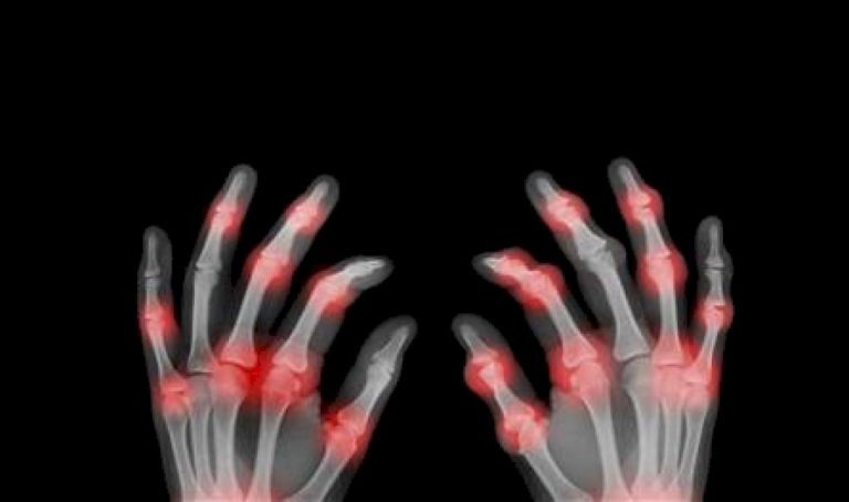 اكتشاف-عامل-وراثي-وراء-مرض-نادر-في-العظام