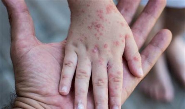 بسبب انخفاض تلقى اللقاح.. بريطانيا تحذّر من تفشي مرض بمعدل خطير بسبب-انخفاض-تلقى-اللقاح.-بريطانيا-تحذّر-من-تفشي-مرض-بمعدل-خطير