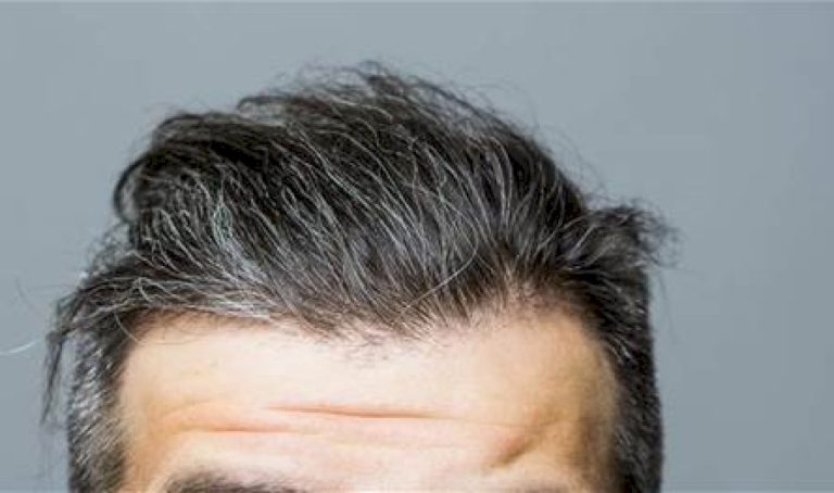 ما-أسباب-الشيب-المبكر-وهل-يمكن-منع-حدوثه؟