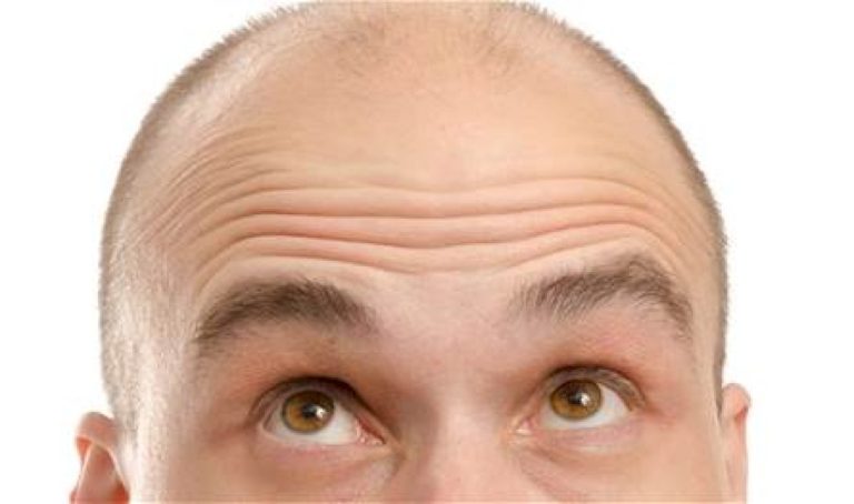 أسباب الصلع المبكر عند الرجال أسباب-الصلع-المبكر-عند-الرجال