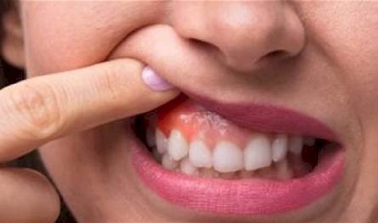 أعراض مؤلمة في فمك تشير إلى الإصابة بالأنفلونزا أعراض-مؤلمة-في-فمك-تشير-إلى-الإصابة-بالأنفلونزا