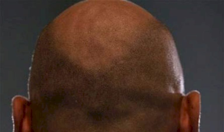 ما-هي-أسباب-الصلع-بين-الذكور؟
