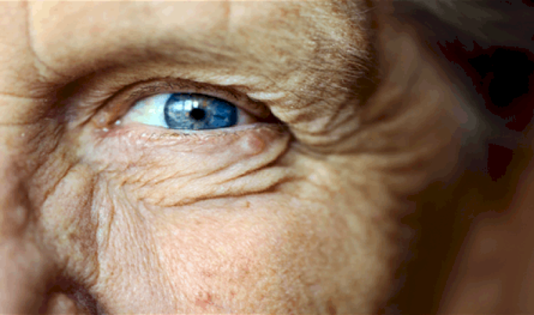 تدلّ على الخرف.. علامة مبكرة تظهر في العين قبل فقدان الذاكرة تدلّ-على-الخرف.-علامة-مبكرة-تظهر-في-العين-قبل-فقدان-الذاكرة