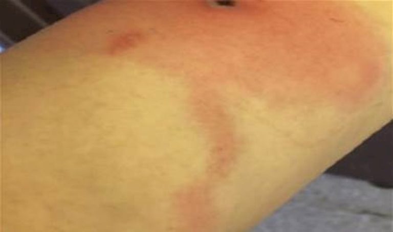 مرض خطير… ما هو "جدري ألاسكا" وكيف ينتقل إلى الإنسان؟ مرض-خطير…-ما-هو-"جدري-ألاسكا"-وكيف-ينتقل-إلى-الإنسان؟