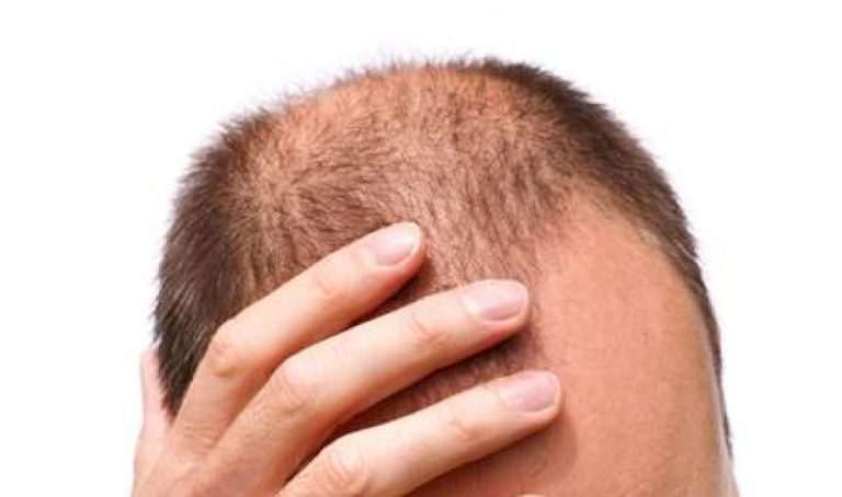 هذه الأطعمة تعزز صحة شعرك وتحميه من التساقط هذه-الأطعمة-تعزز-صحة-شعرك-وتحميه-من-التساقط