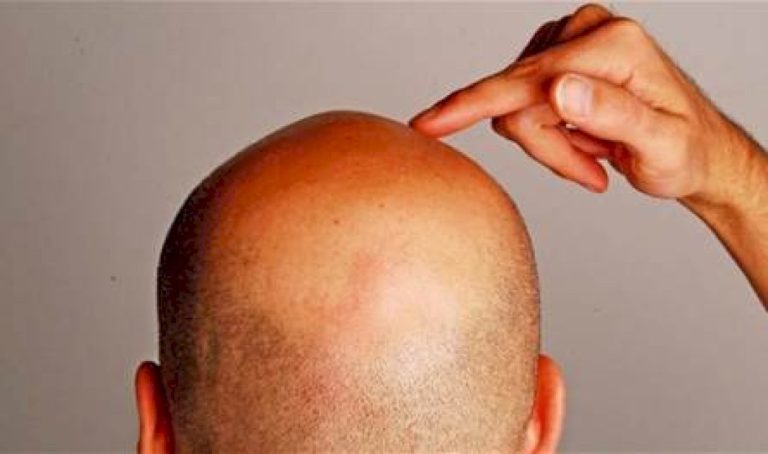 تأثير-كبير-للحياة-العصرية.-ترفع-معدلات-الصلع-لدى-الشباب