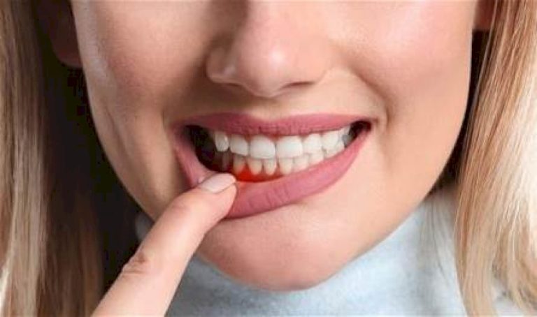 علاج-التهاب-اللثة-ونظافة-الفم
