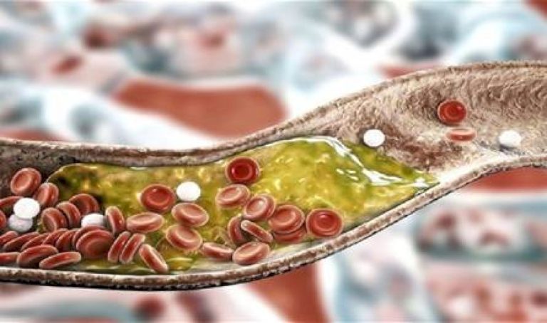 هل هناك علاقة بين تساقط الشعر وارتفاع الكوليسترول؟ هل-هناك-علاقة-بين-تساقط-الشعر-وارتفاع-الكوليسترول؟