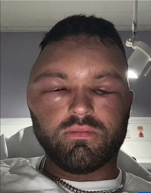 رجل ذهب ليصبغ شعره فانتفخ رأسه كبالون عملاق رجل-ذهب-ليصبغ-شعره-فانتفخ-رأسه-كبالون-عملاق