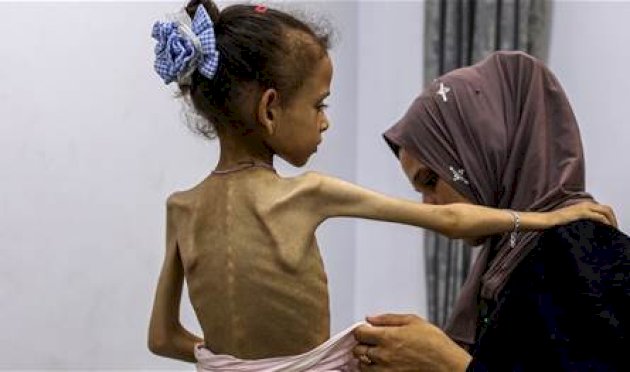 المجاعة لا تنتهي بالغذاء.. بل يترك ندوبًا في الجينات تمتد لأجيال المجاعة-لا-تنتهي-بالغذاء.-بل-يترك-ندوبًا-في-الجينات-تمتد-لأجيال