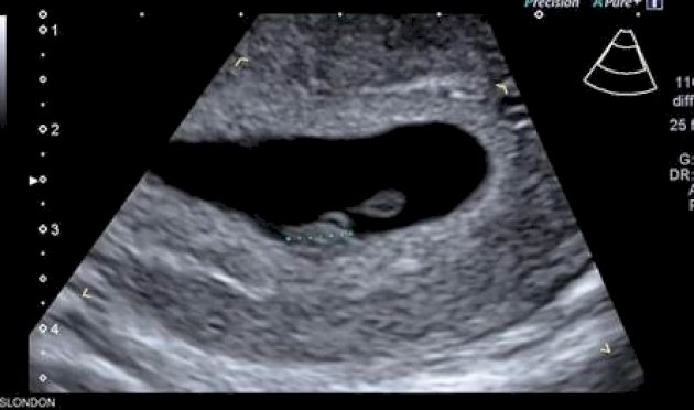 ذكاء اصطناعي يحدّد موعد الولادة بدقة غير مسبوقة عبر صور الموجات فوق الصوتية ذكاء-اصطناعي-يحدّد-موعد-الولادة-بدقة-غير-مسبوقة-عبر-صور-الموجات-فوق-الصوتية