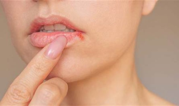 ما هو "هربس الشفاه"؟ تعرفوا إلى "فيروس" البثور المؤلمة ما-هو-"هربس-الشفاه"؟-تعرفوا-إلى-"فيروس"-البثور-المؤلمة