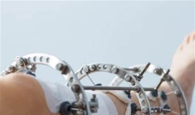 فوائد-مثيرة-ومخاطر-مقلقة.-هذا-ما-يجب-ان-تعرفوه-عن-جراحة-إطالة-العظام-لأسباب-تجميلية