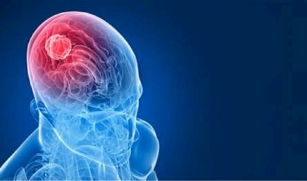 قد-يكشف-ورم-في-الدماغ.-7-أعراض-مبكرة-لا-يجب-تجاهلها!