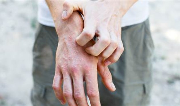 الطعام.-هل-بإمكانه-التخفيف-من-الأكزيما؟