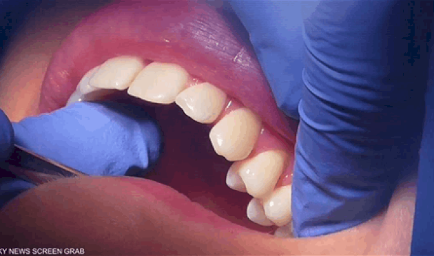 هلام-ثوري-يُصلح-الأسنان-التالفة-دون-جراحة