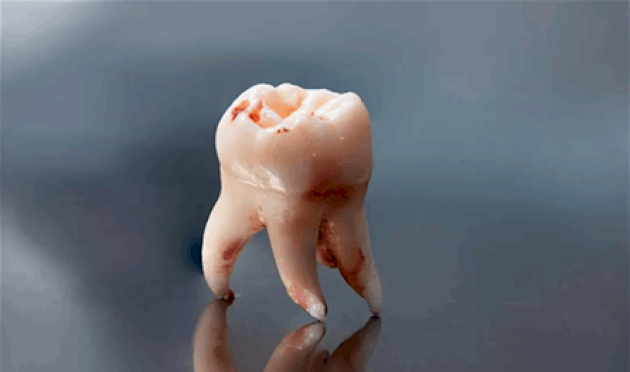 بعد-خلع-ضرس-العقل.-4-مشروبات-يجب-الابتعاد-عنها