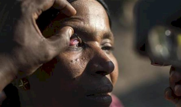 "العمى-النهري".-مرض-خطير-ينتشر-في-هذه-الدول!