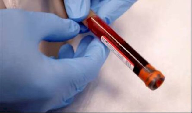 تقدّم علمي ثوري.. اختبار دم منزلي يكشف علامات مرض ألزهايمر تقدّم-علمي-ثوري.-اختبار-دم-منزلي-يكشف-علامات-مرض-ألزهايمر