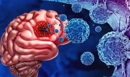 أورام الدماغ بين الأولية والثانوية… وهذه أبرز الإشارات التحذيرية أورام-الدماغ-بين-الأولية-والثانوية…-وهذه-أبرز-الإشارات-التحذيرية