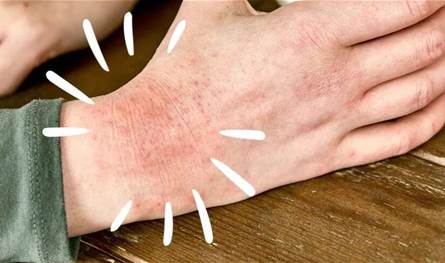 نصائح-للتخلص-من-مشكلة-إكزيما-الشتاء.-هذا-ما-يجب-فعله