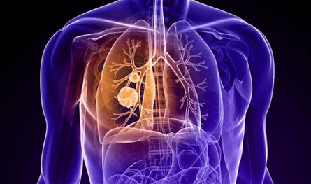 علماء يكتشفون آلية دفاع الخلايا السرطانية ضد العلاج علماء-يكتشفون-آلية-دفاع-الخلايا-السرطانية-ضد-العلاج