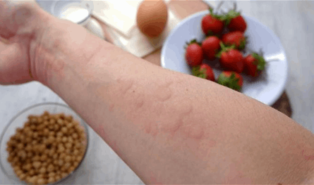 توقف-عالمي-للدواء-الوحيد-لحساسية-الفول-السوداني