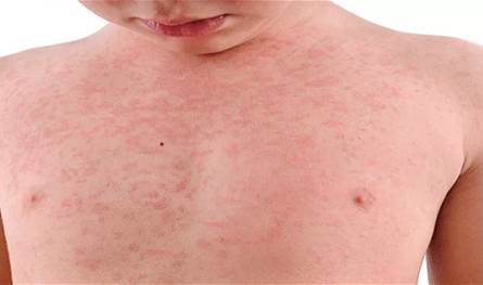 تحذيرات-صحية-مع-تزايد-حالات-الحصبة
