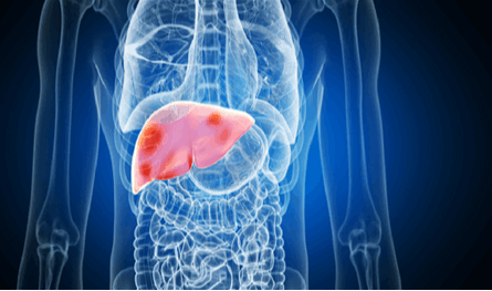 هل-الصيام-آمن-لمرضى-الكبد؟