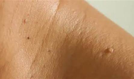 احذر.-الزوائد-الجلدية-الصغيرة-قد-تكون-مؤشّرًا-على-مشكلة-خفية!