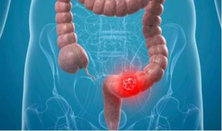 احمِ أمعاءك.. 4 أطعمة تقلل خطر الإصابة بسرطان القولون! احمِ-أمعاءك.-4-أطعمة-تقلل-خطر-الإصابة-بسرطان-القولون!